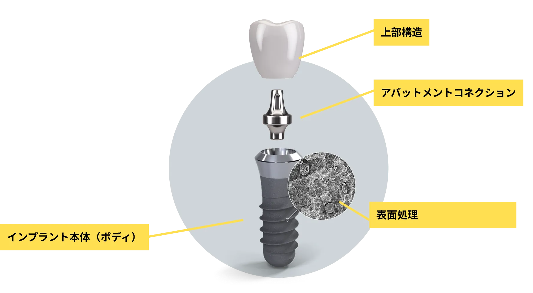 インプラントの構造