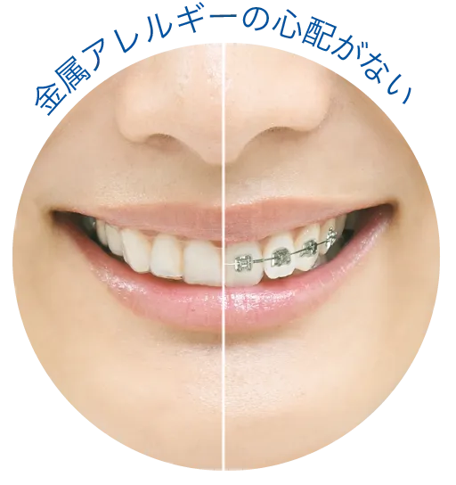金属アレルギーの心配がない