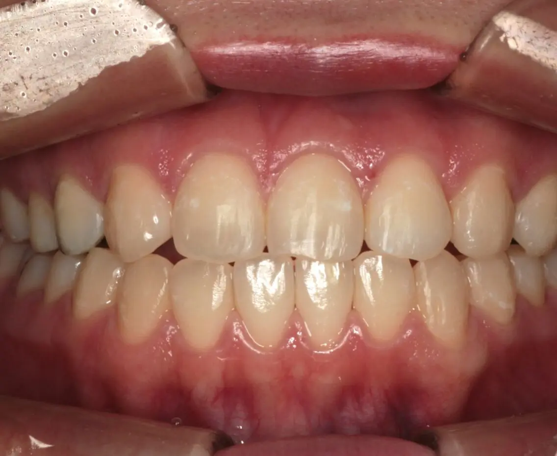 マウスピース矯正症例:after画像