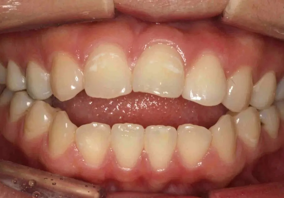 マウスピース矯正症例:before画像